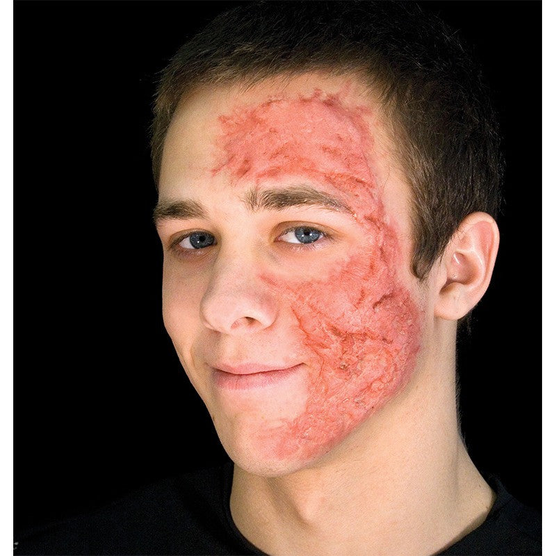 burn wound face
